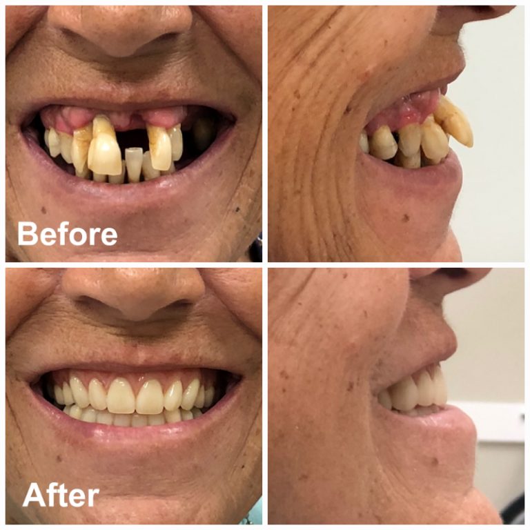 Dentures Ottawa Denture Clinic And Denturist Rockcliffe Dental