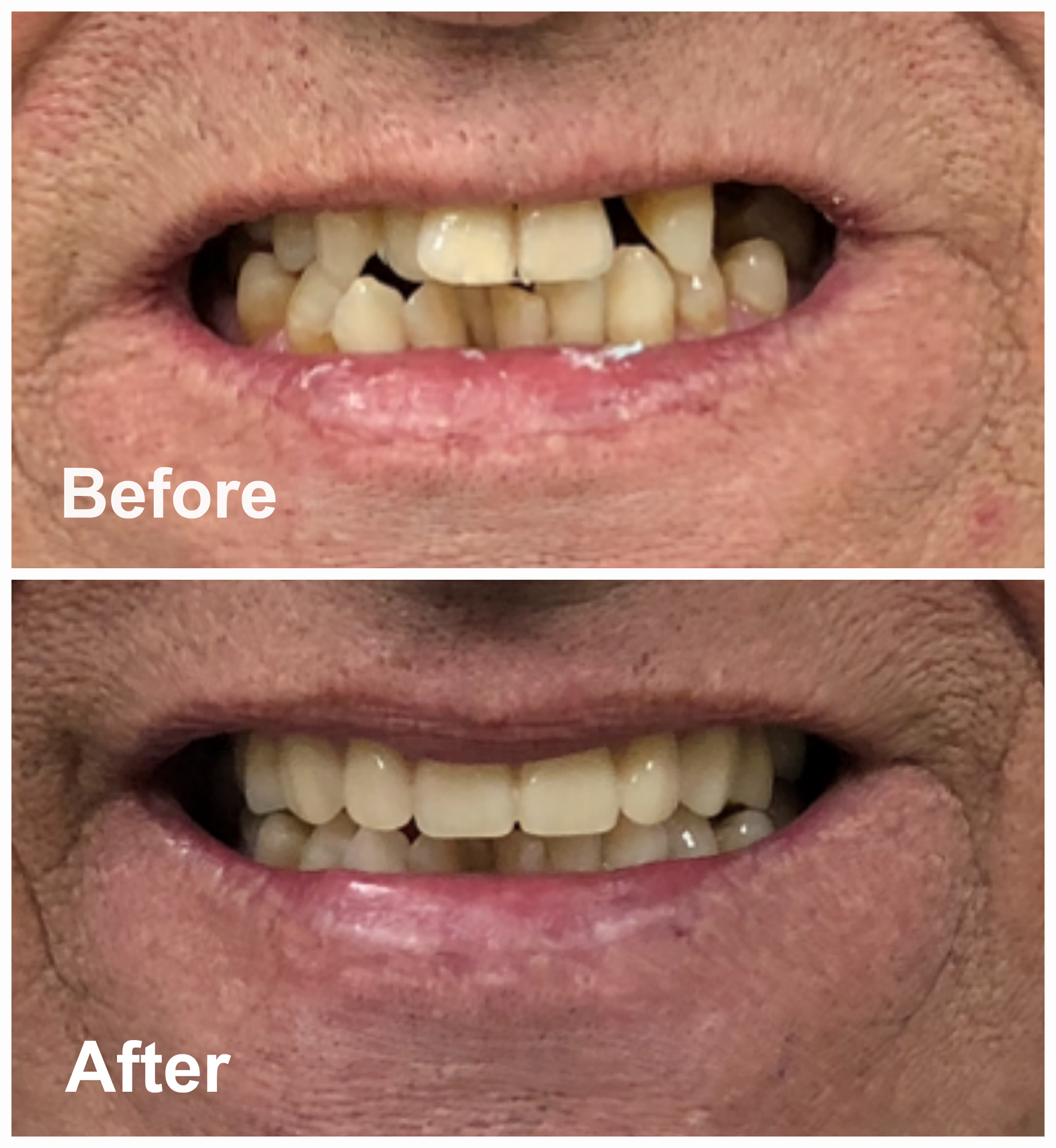 Immediate Upper Dentures Before After Photos