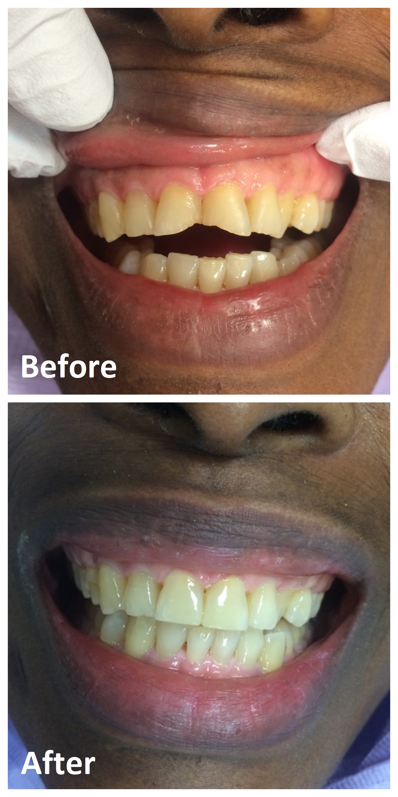 Composite Fillings Front Teeth Before and After | White Fillings Ottawa