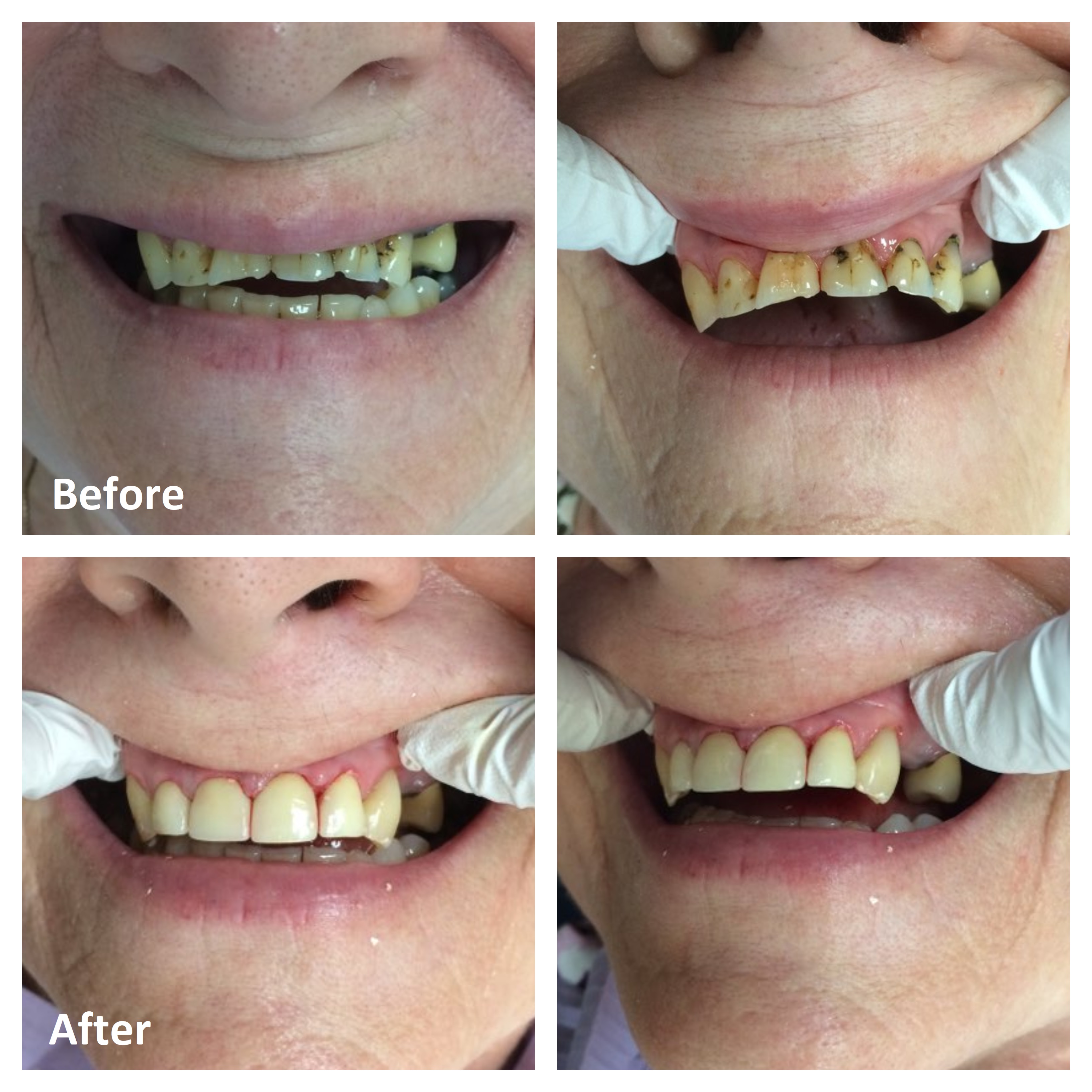 Front Teeth Fillings Before and After