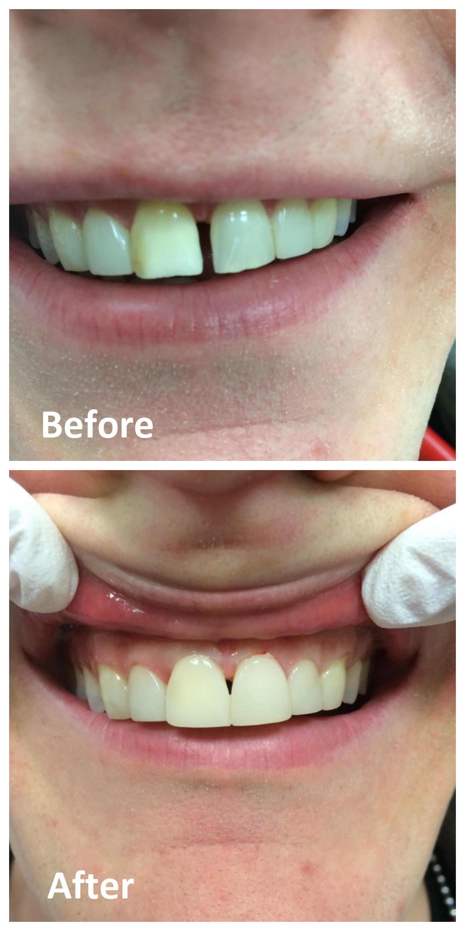 Cosmetic Dentistry Before After Photos | Cosmetic Dentist Ottawa