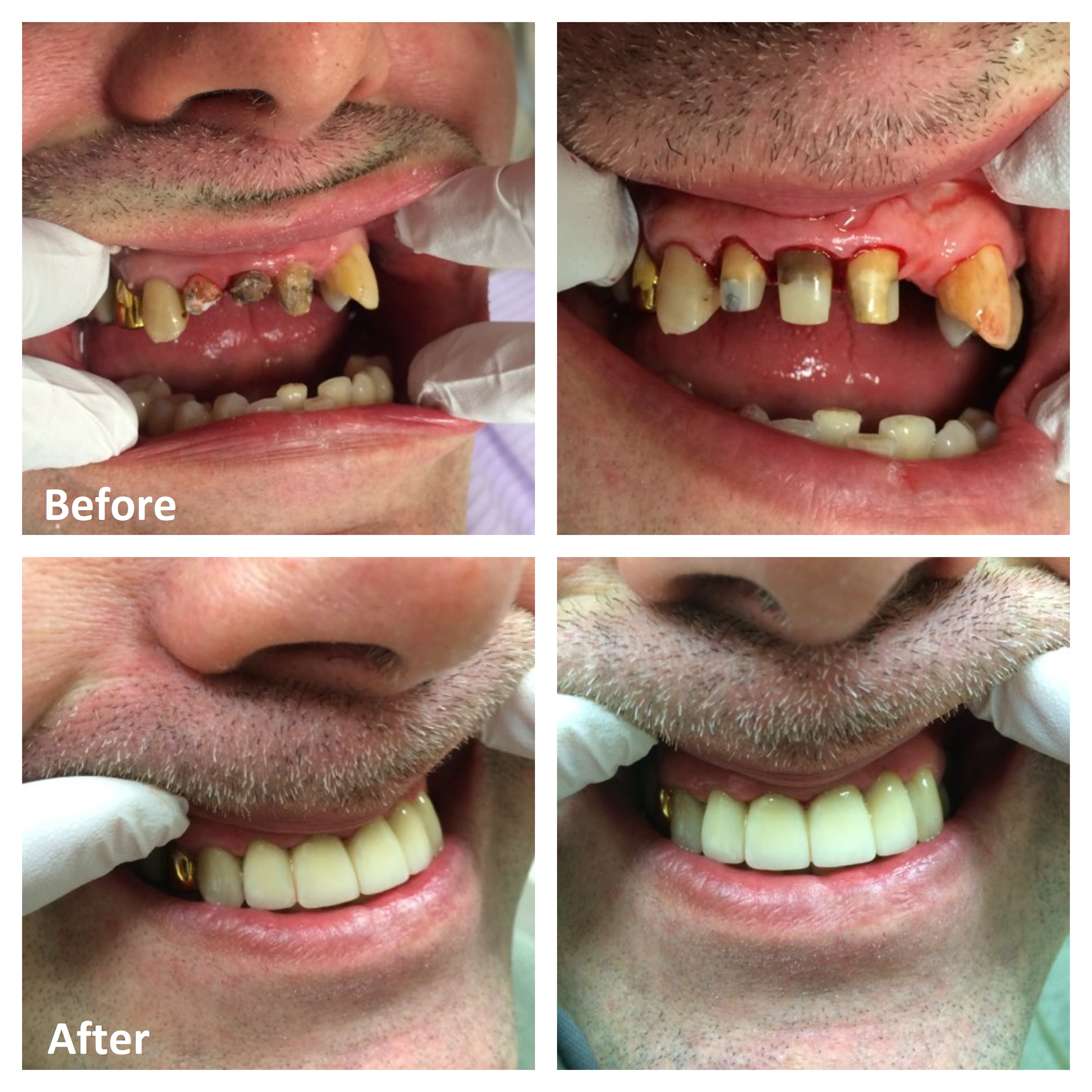 molar crown before after