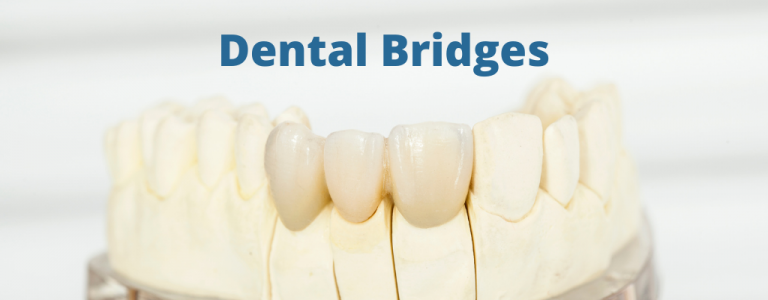 Tooth Crowns & Dental Bridges Ottawa | Restorative Dentistry