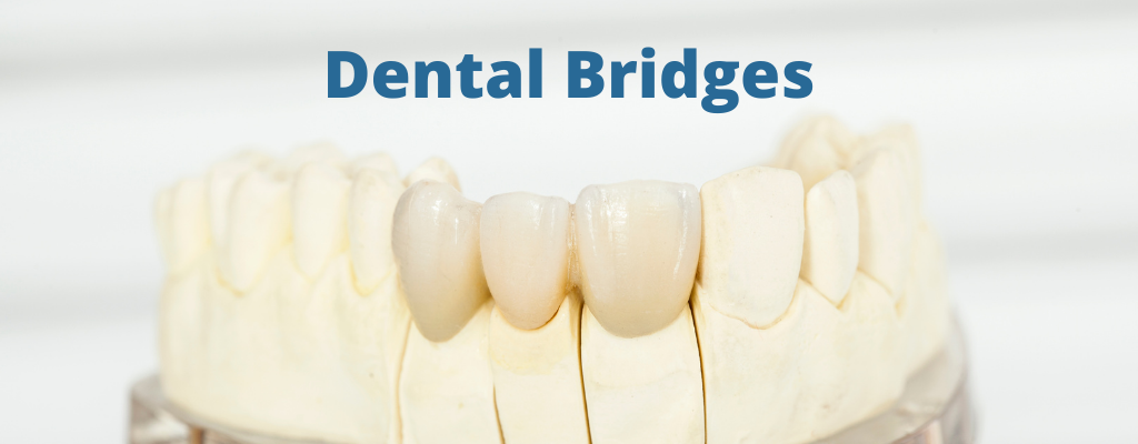 Dental Bridges Ottawa | Rockcliffe Dental & Denture Centre
