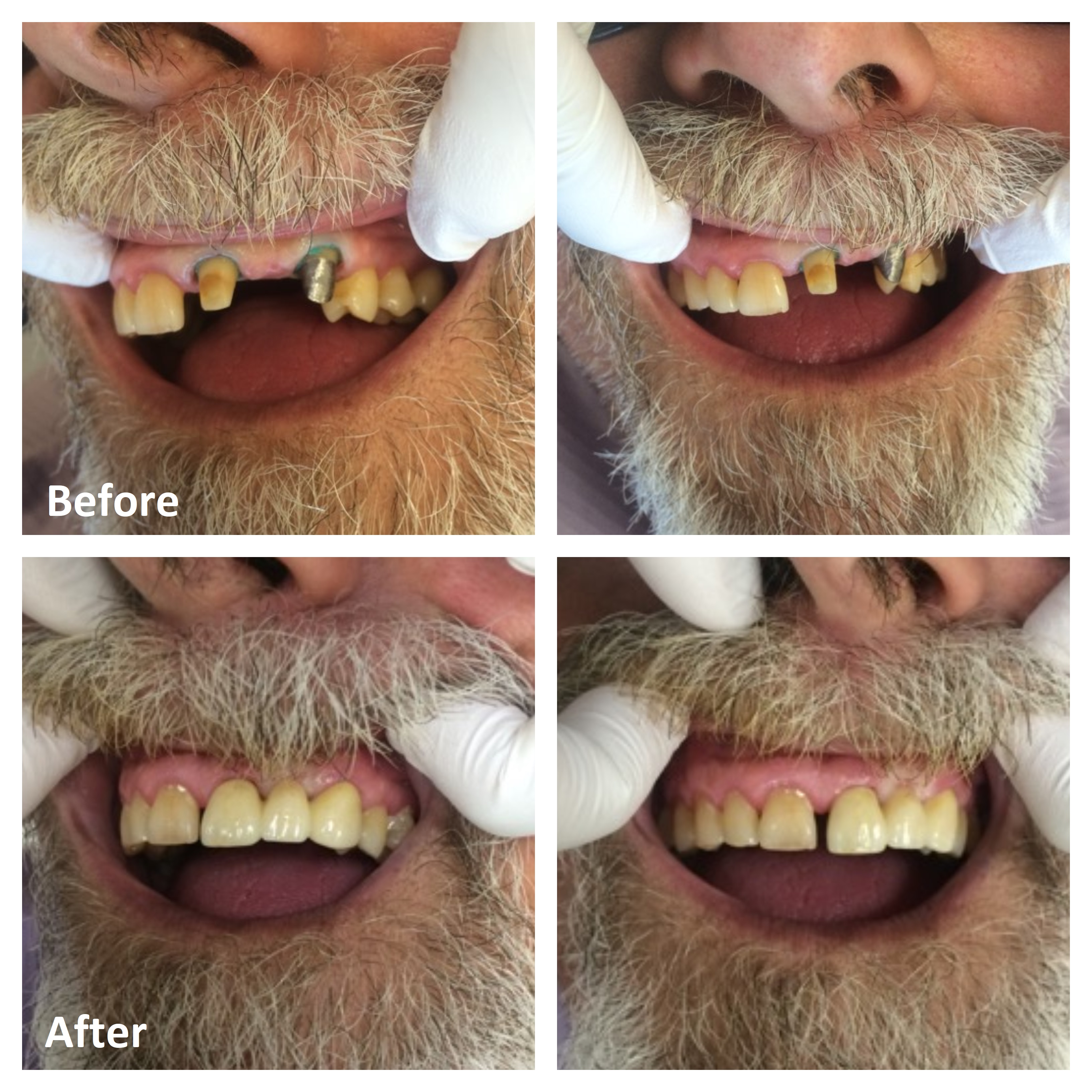 Dental Bridge Front Teeth Before and After | Ottawa Dentist