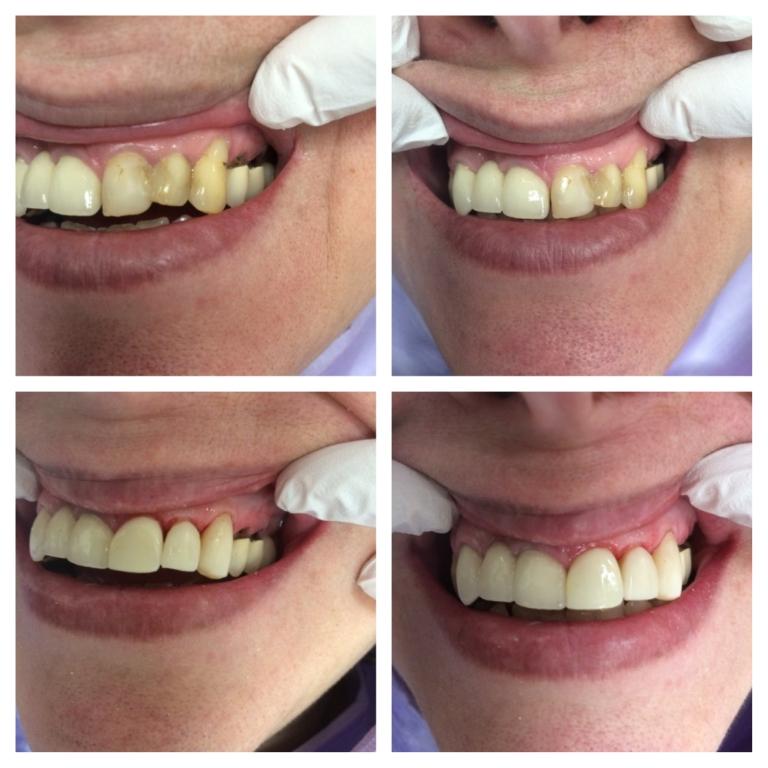 Dental Bridge Before and After Pics | Dental Clinic Ottawa