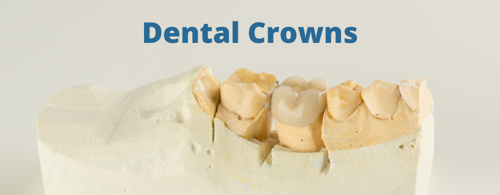 Dental Crowns Ottawa | Rockcliffe Dental & Denture Centre