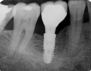 Single Tooth Implant | Rockcliffe Dental & Denture Centre