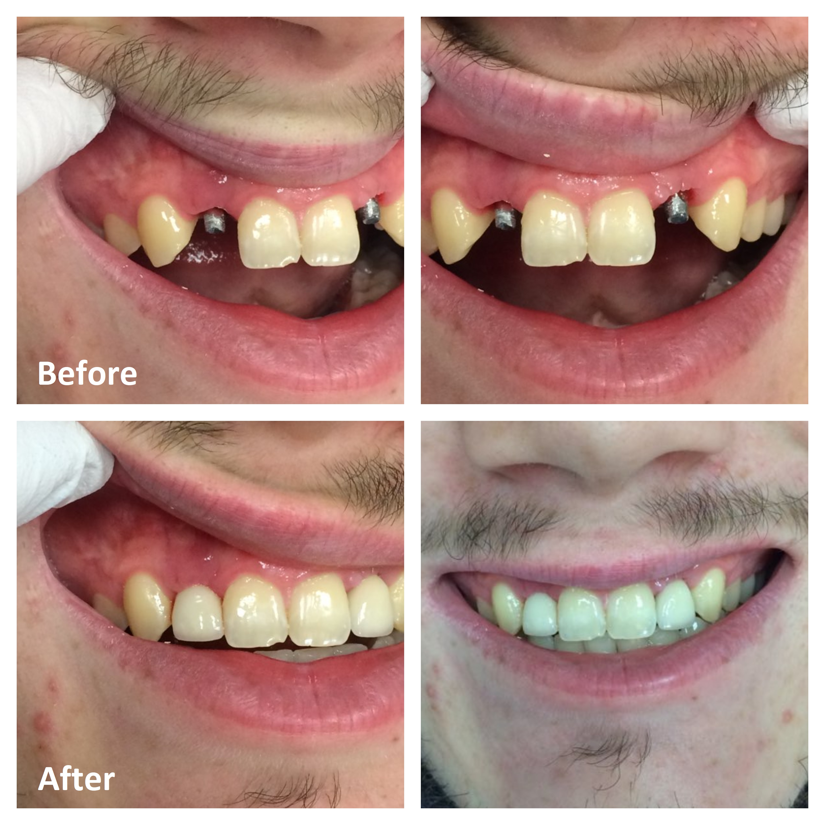 Single Tooth Implants Before and After | Dental Implants Ottawa