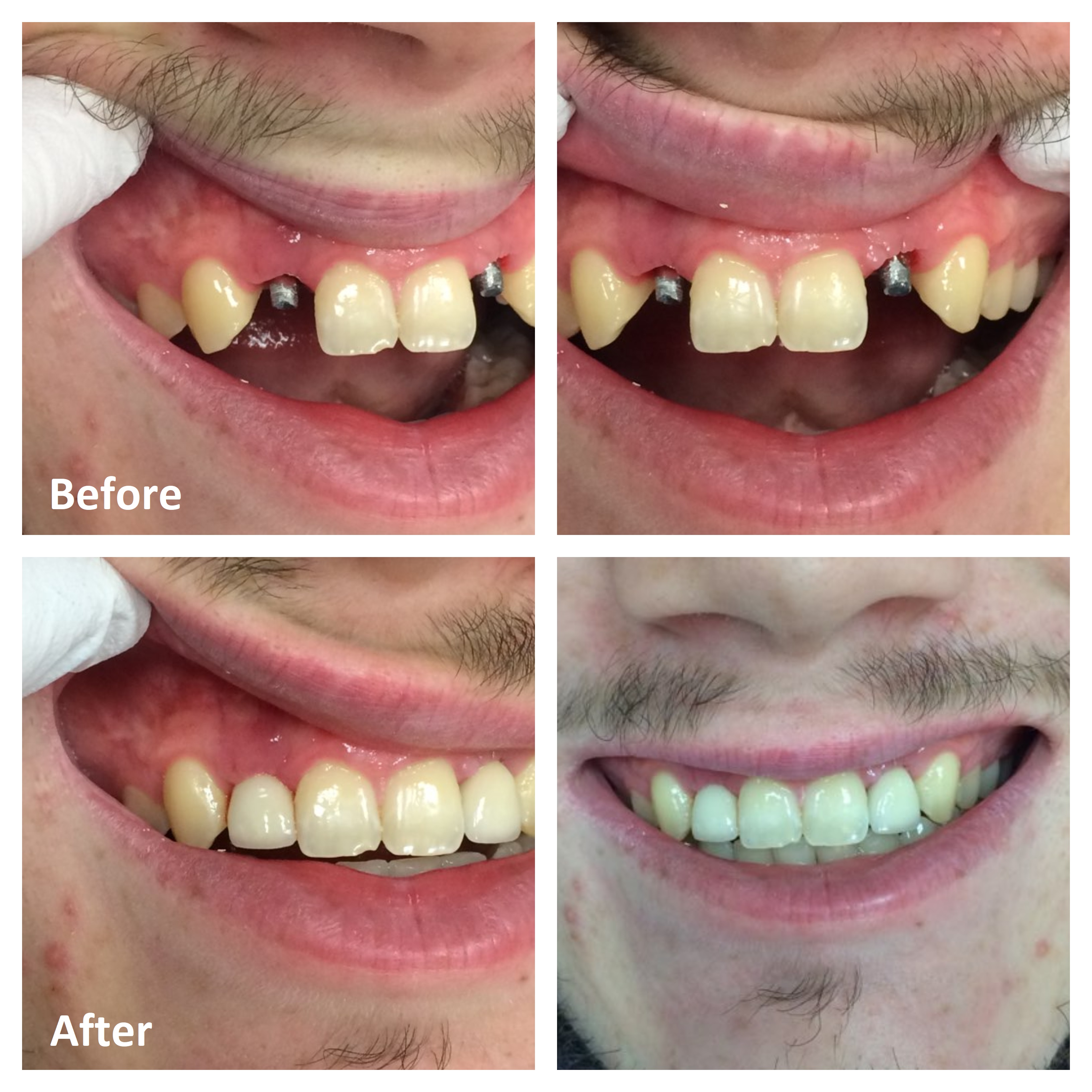 single-tooth-dental-implant-ottawa-front-tooth-replacement