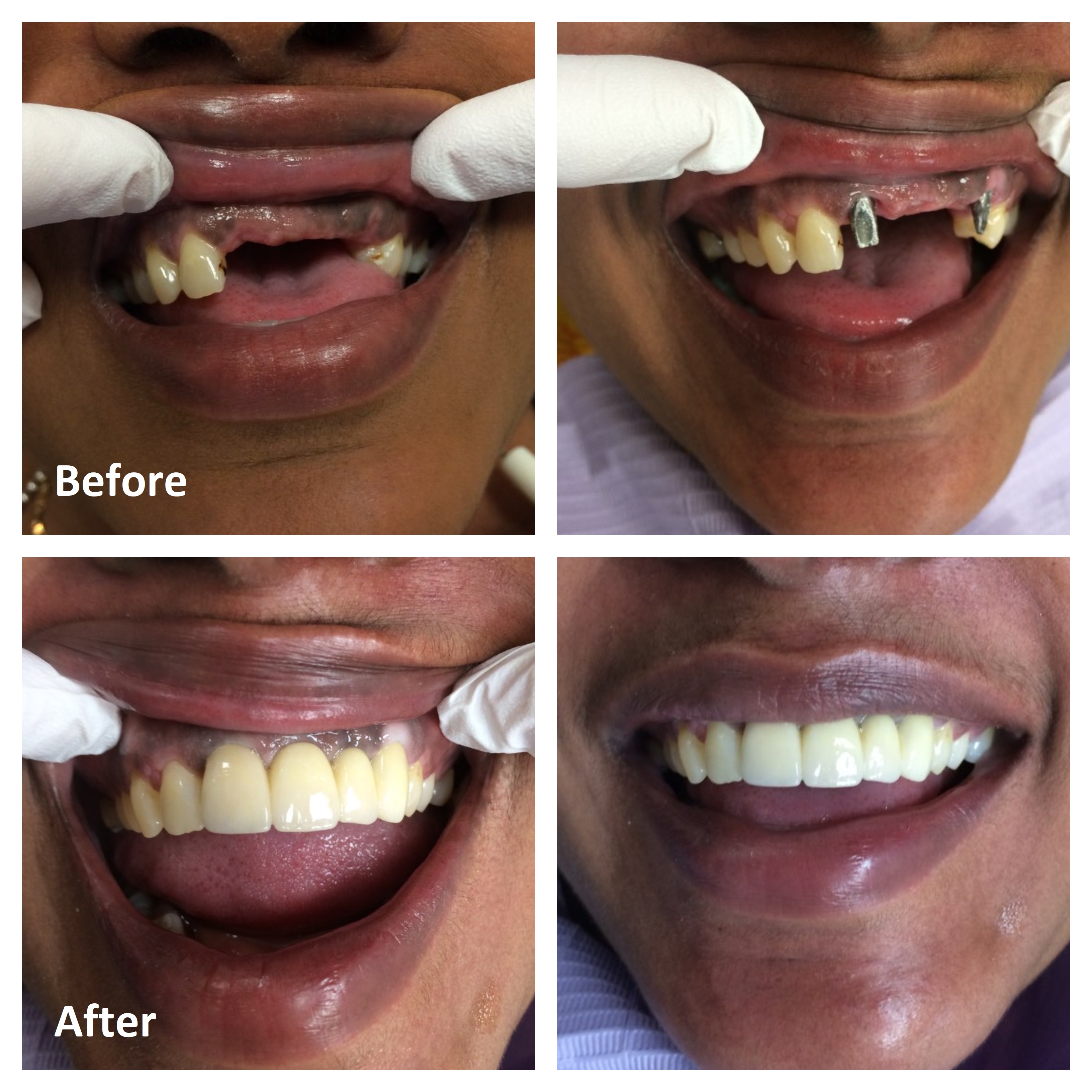 Dental Implant Surgery Before and After | Ottawa Dentist