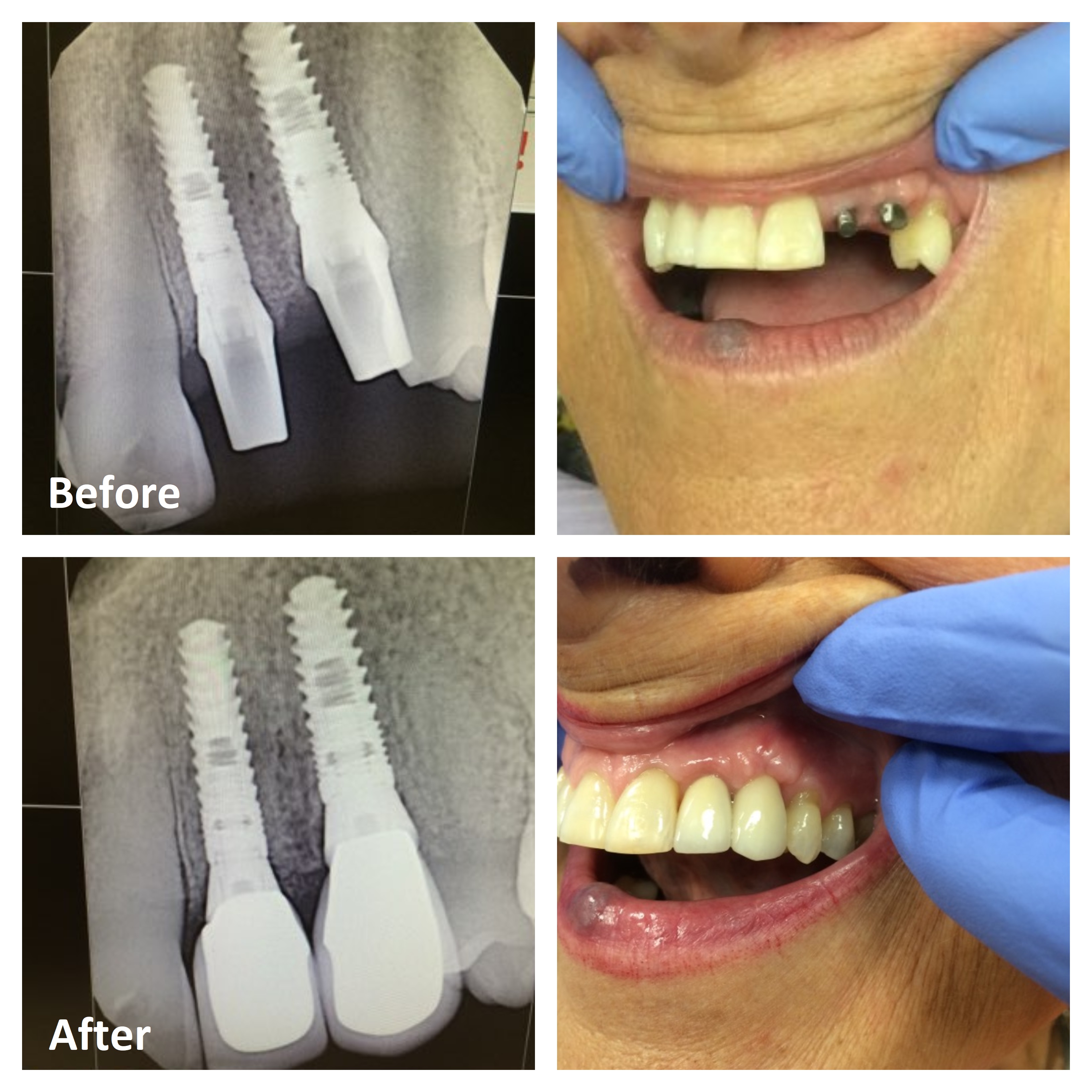 Dental Implant Pictures Before and After | Implant Dentist Ottawa