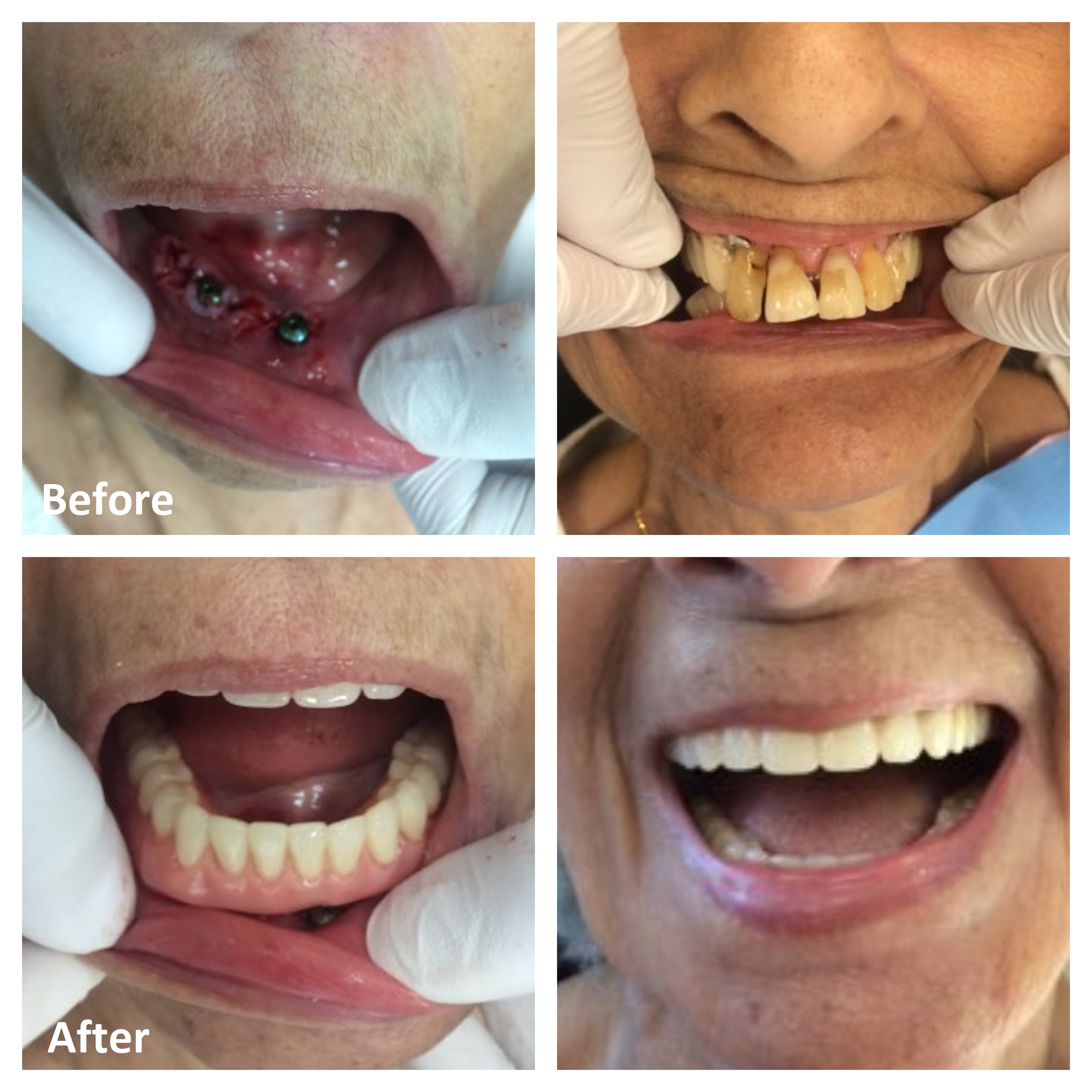 Complete Dentures Before and After Pictures | Denturist Ottawa