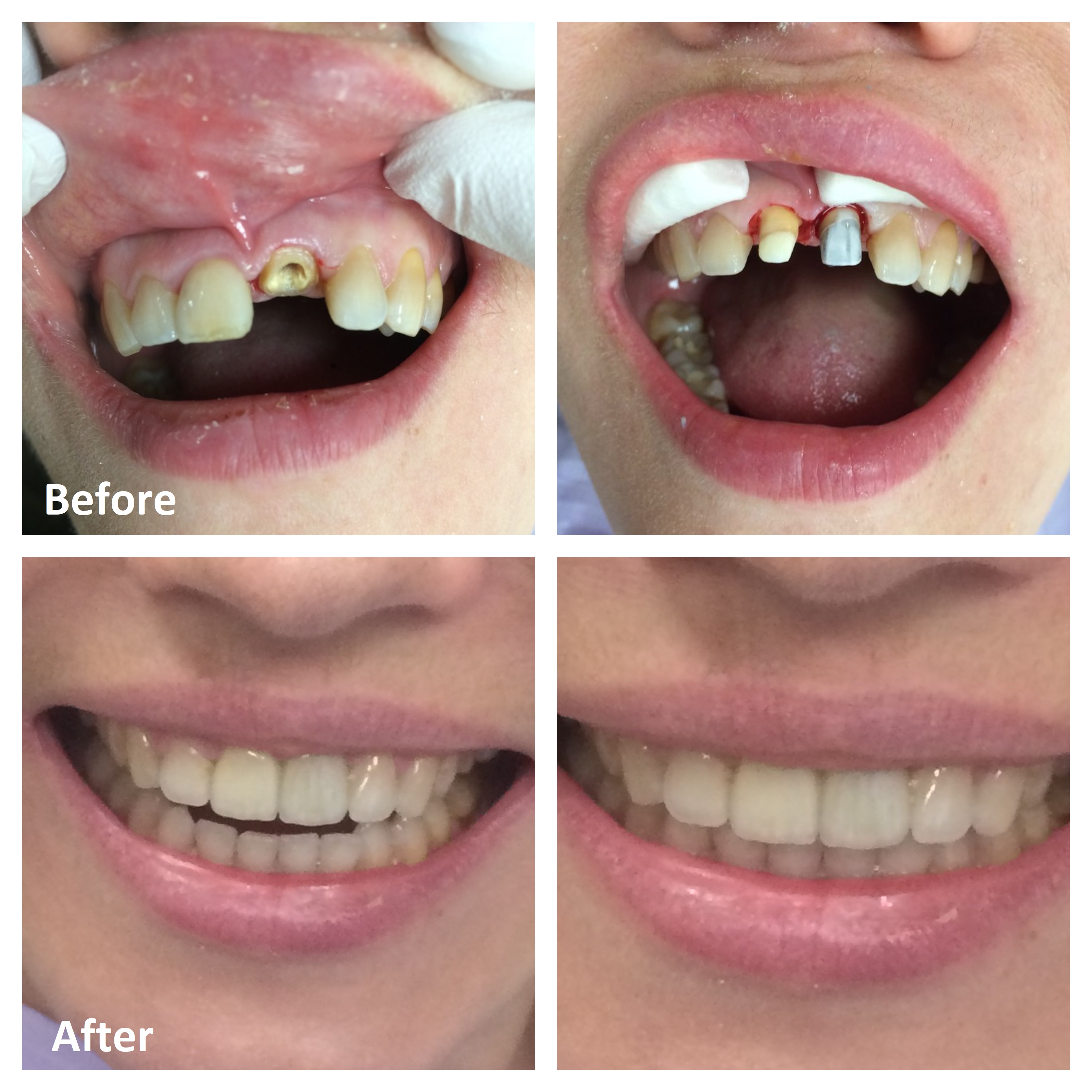Broken Tooth Before & After | Emergency Dentist Ottawa