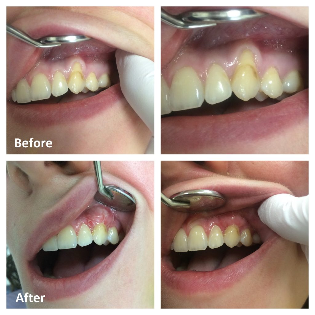 Gum Graft Before and After Photos.
