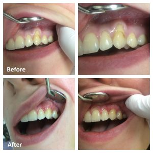 Gum Tissue Graft Before and After | Gum Grafts Ottawa