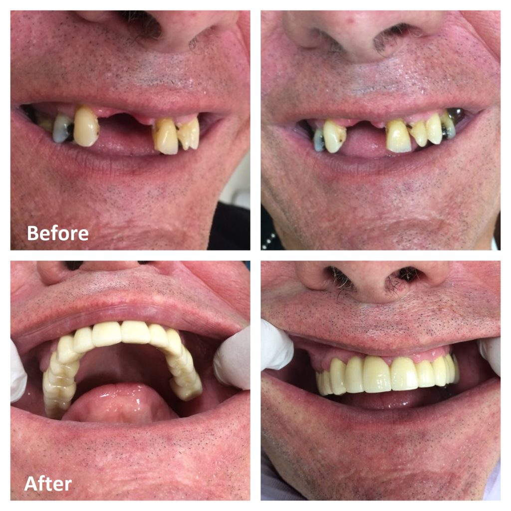 Smile Makeover Ottawa | Full Mouth Reconstruction