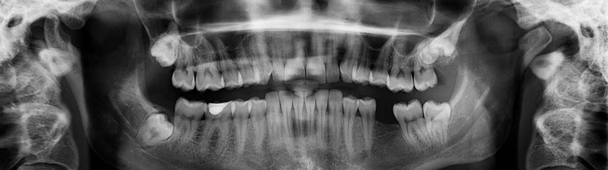 Dental Crown Procedure Ottawa | Tooth Crown
