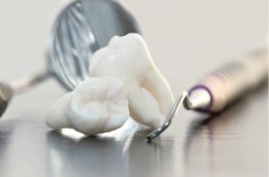Risks of Wisdom Tooth Extraction | Rockcliffe Dental & Denture Centre
