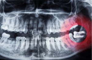 Growing out sideways tooth Tooth Growing