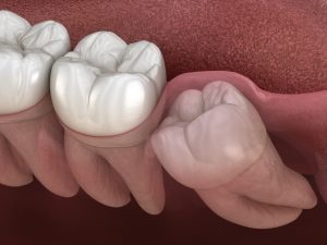 Wisdom Tooth Impaction | Rockcliffe Dental & Denture Centre