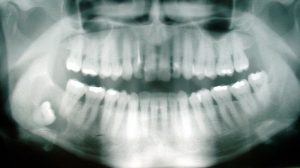 Wisdom Teeth Coming In: Signs & Symptoms