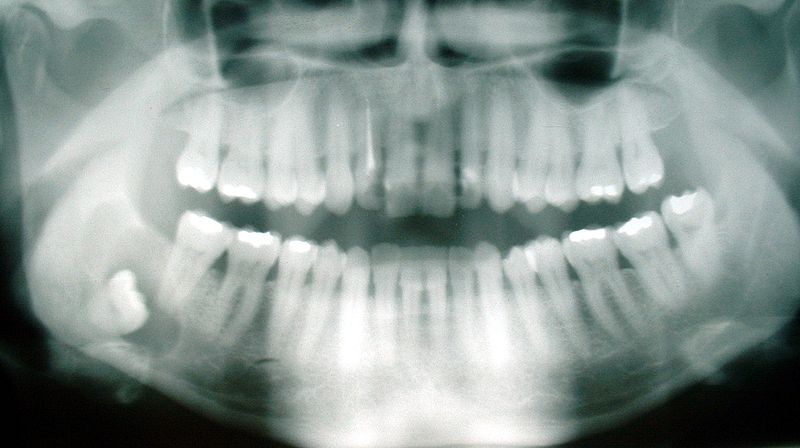 wisdom-teeth-coming-in-signs-symptoms-ottawa-dentist