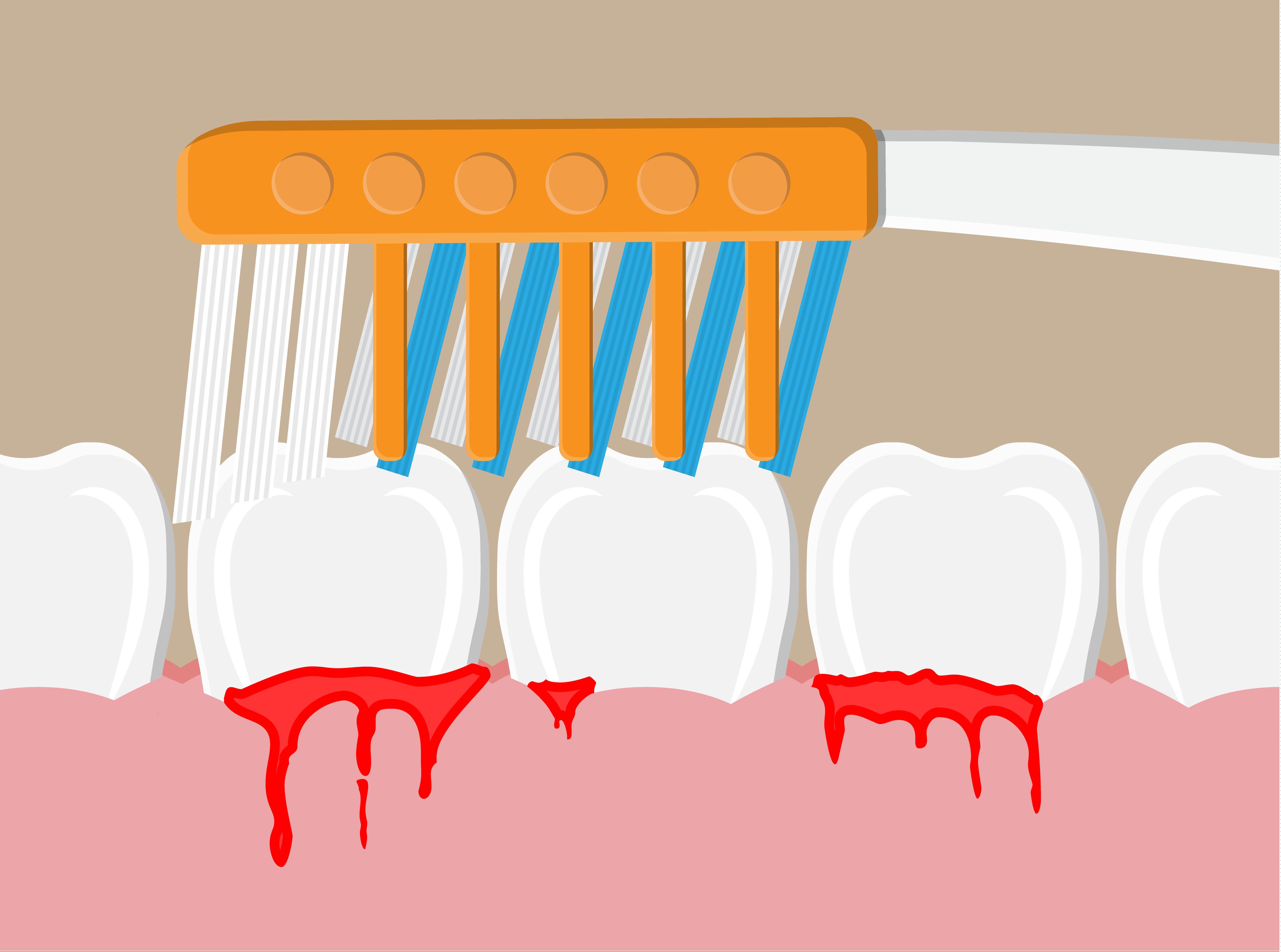 Чистка зубов кровоточивость