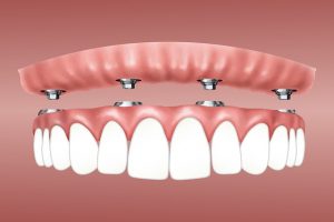 Dental Implant Procedure in Ottawa | Implant Dentist | Rockcliffe Dental & Denture Centre