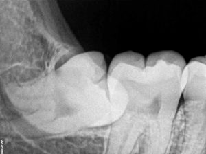 Tooth Extraction Ottawa | Impacted Wisdom Teeth | Rockcliffe Dental & Denture Centre