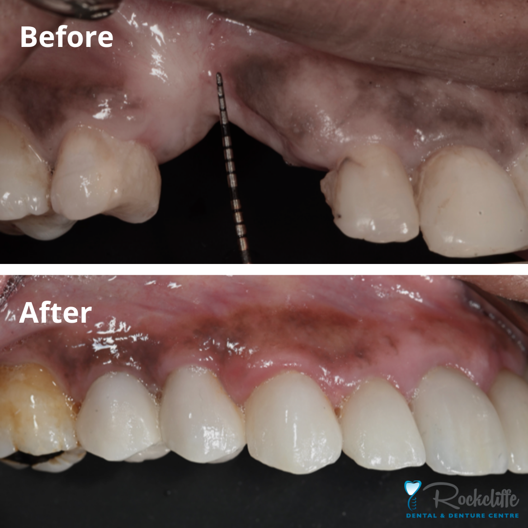 Dental Bone Graft Healing Timeline at williamajoneso blog