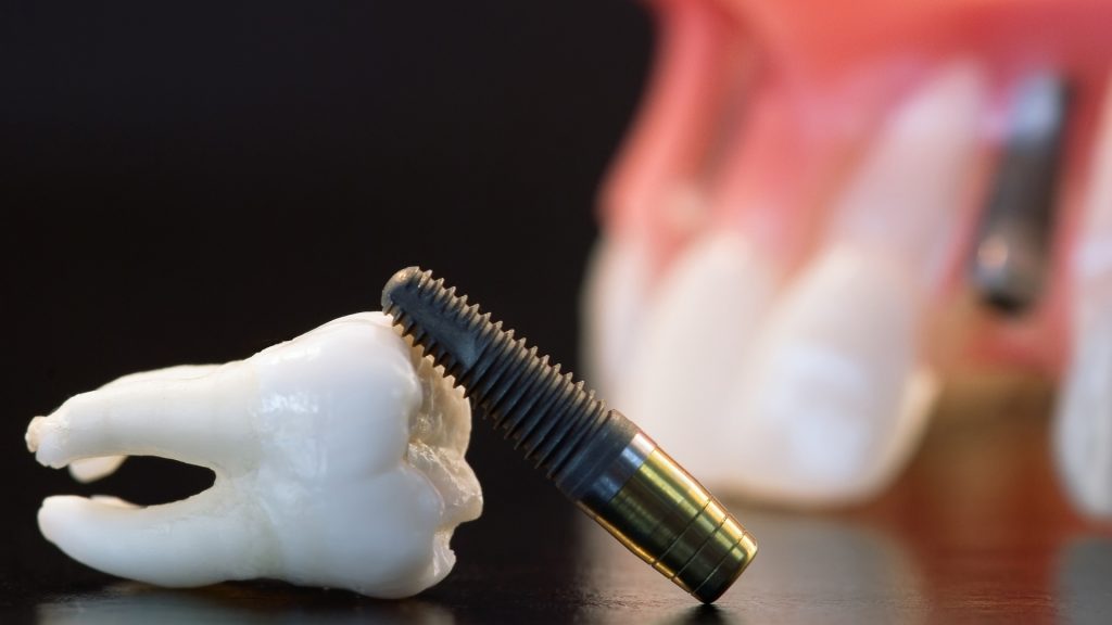 Benefits of Socket Preservation Bone Grafting | Rockcliffe Dental & Denture Centre