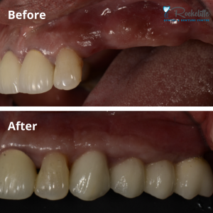 implant supported bridge