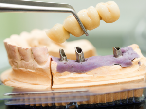 Implant-Supported Bridges | Implant Bridges | Rockcliffe Dental & Denture Centre