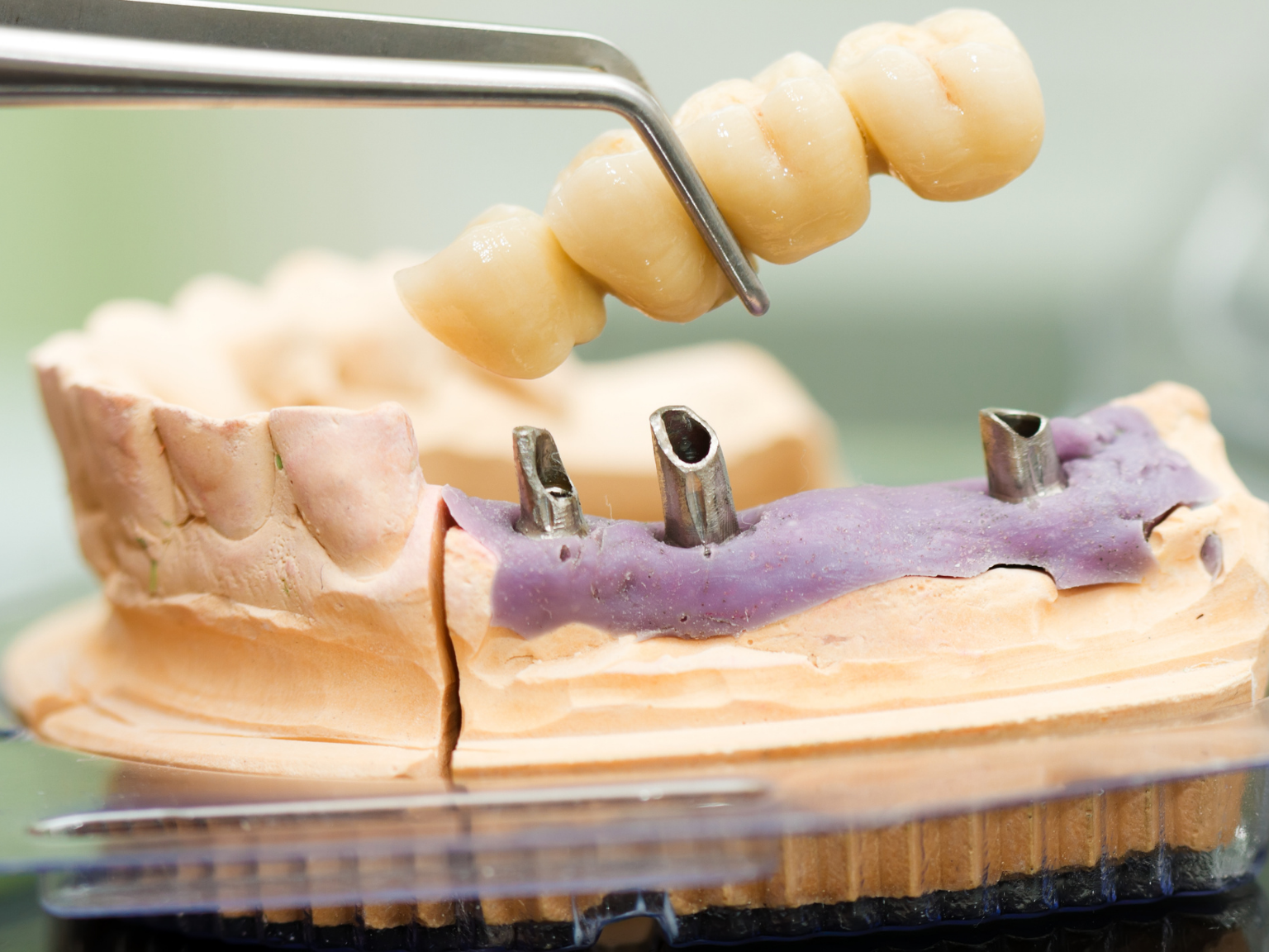 Dental Implant Bridges Implant Supported Bridges