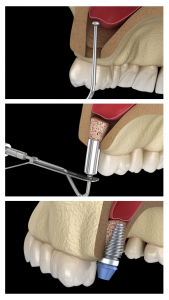 Sinus Lift Procedure | Ottawa | Rockcliffe Dental & Denture Centre