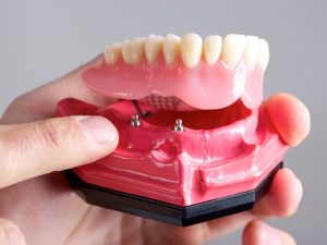 Snap On Dentures | Snap In Teeth | Implant Overdentures Ottawa | Rockcliffe Dental