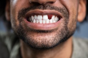 How Can You Lose a Tooth as an Adult? | Rockcliffe Dental & Denture Centre